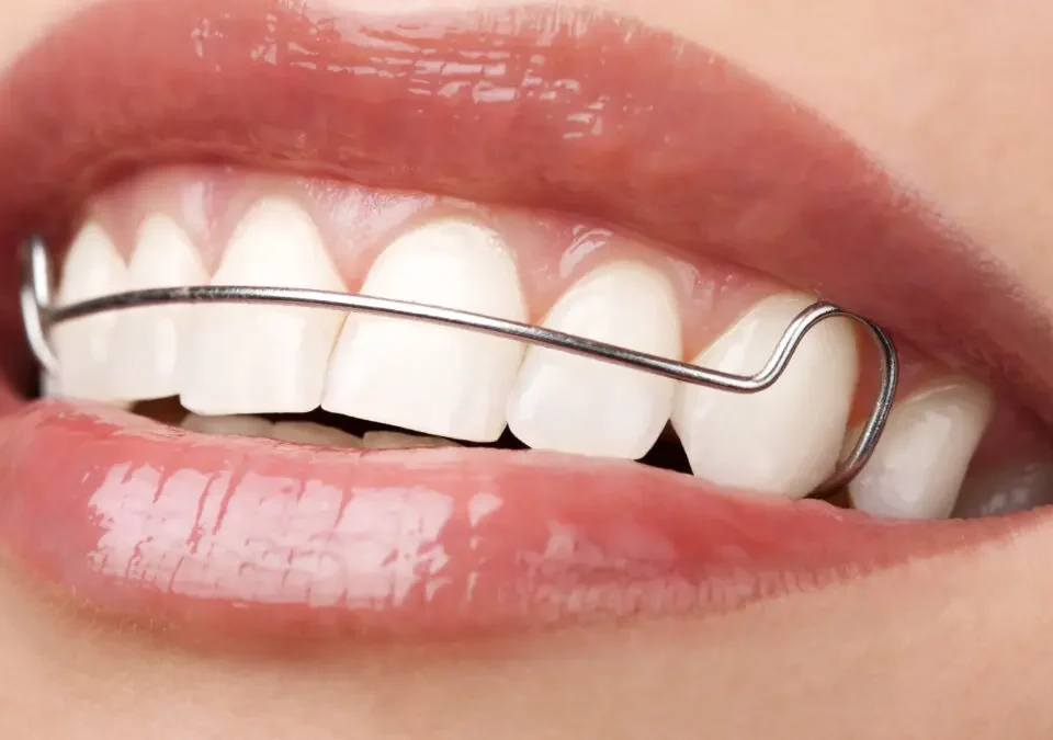 Sorriso com contenção dentária.